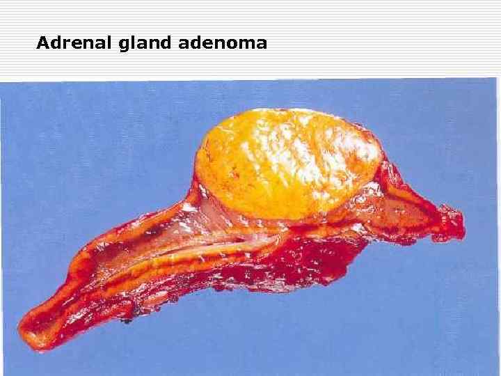 Adrenal gland adenoma 
