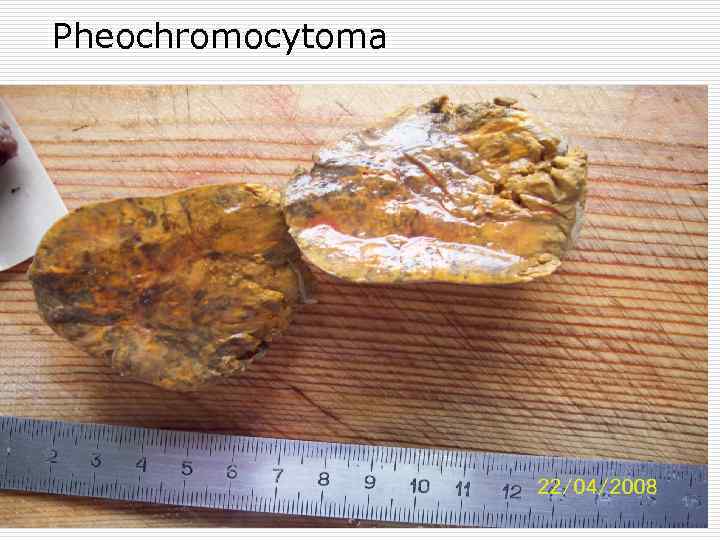 Pheochromocytoma 