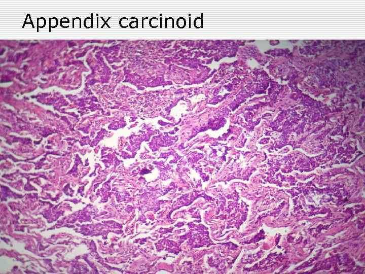 Appendix carcinoid 