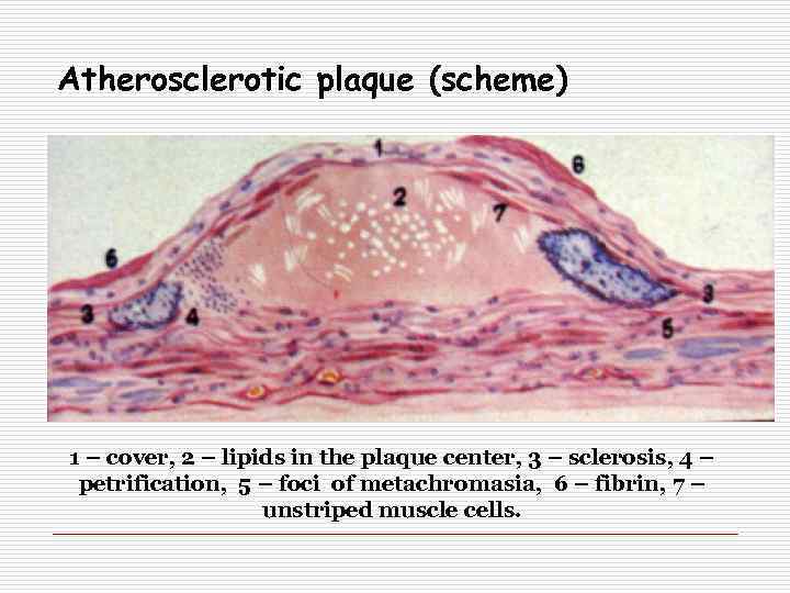 Atherosclerotic plaque (scheme) 1 – cover, 2 – lipids in the plaque center, 3