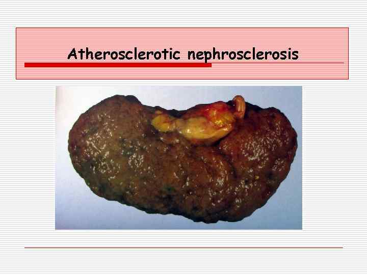 Atherosclerotic nephrosclerosis 