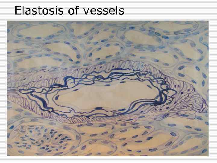 Elastosis of vessels 