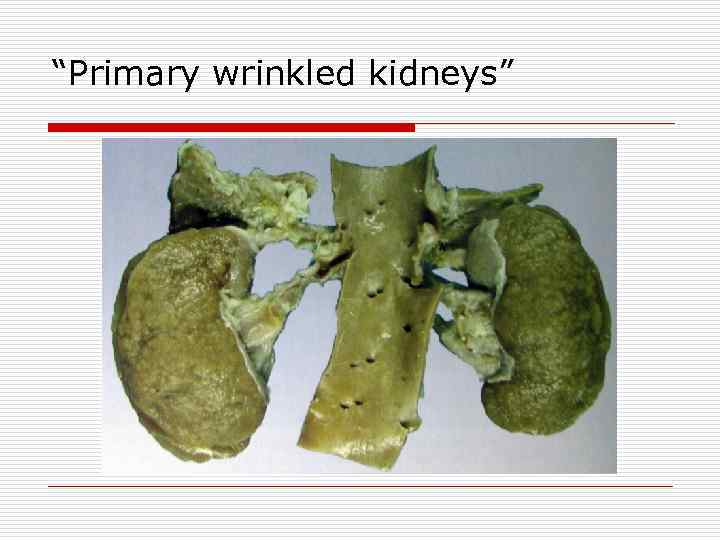 “Primary wrinkled kidneys” 