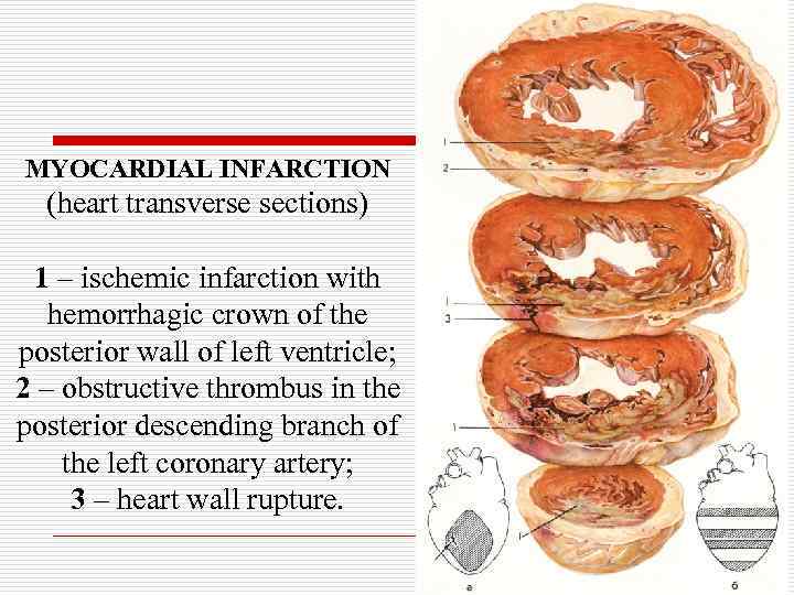 MYOCARDIAL INFARCTION (heart transverse sections) 1 – ischemic infarction with hemorrhagic crown of the