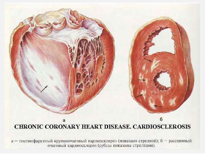 CHRONIC CORONARY HEART DISEASE. CARDIOSCLEROSIS 