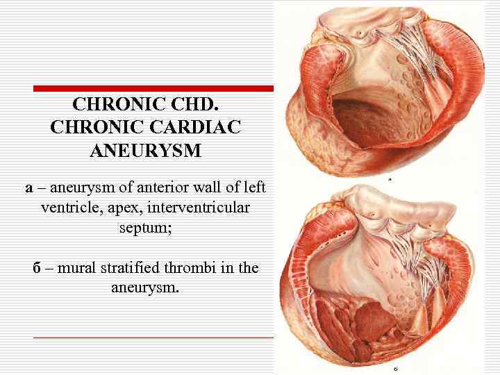 CHRONIC CHD. CHRONIC CARDIAC ANEURYSM а – aneurysm of anterior wall of left ventricle,