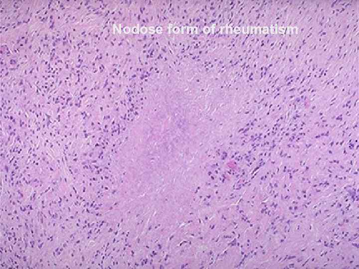 Nodose form of rheumatism 