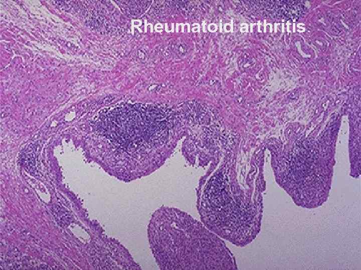 Rheumatoid arthritis Ревматоидный артрит 