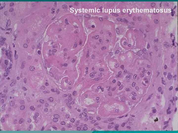 Systemic lupus erythematosus 