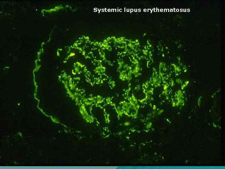 Systemic lupus erythematosus 