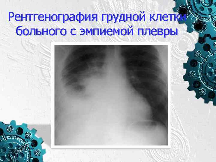 Рентгенография грудной клетки больного с эмпиемой плевры 