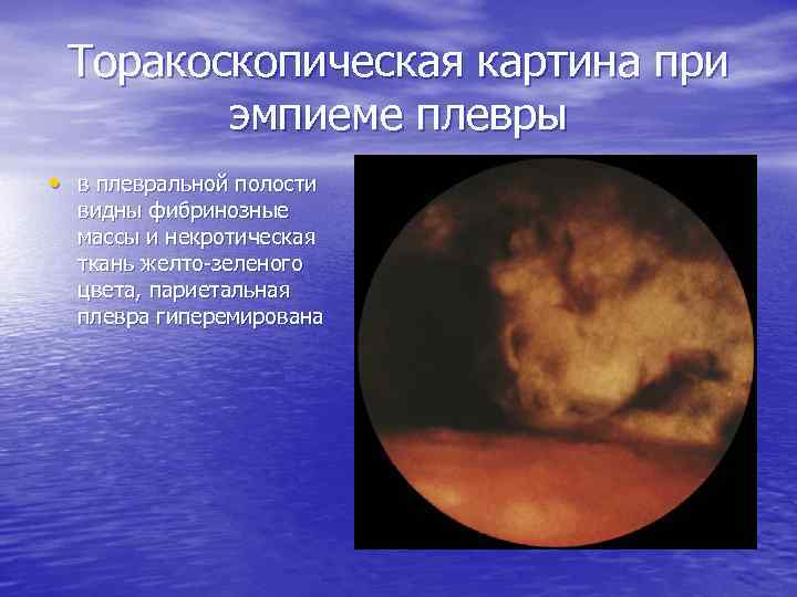 Торакоскопическая картина при эмпиеме плевры • в плевральной полости видны фибринозные массы и некротическая