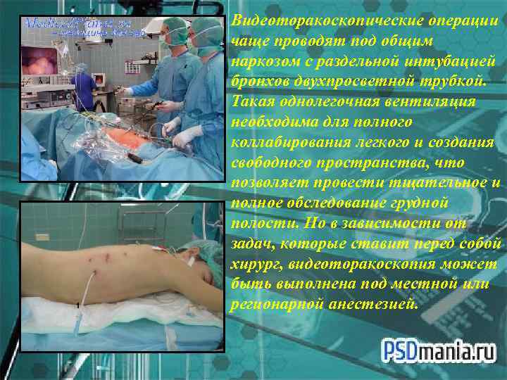 Видеоторакоскопические операции чаще проводят под общим наркозом с раздельной интубацией бронхов двухпросветной трубкой. Такая