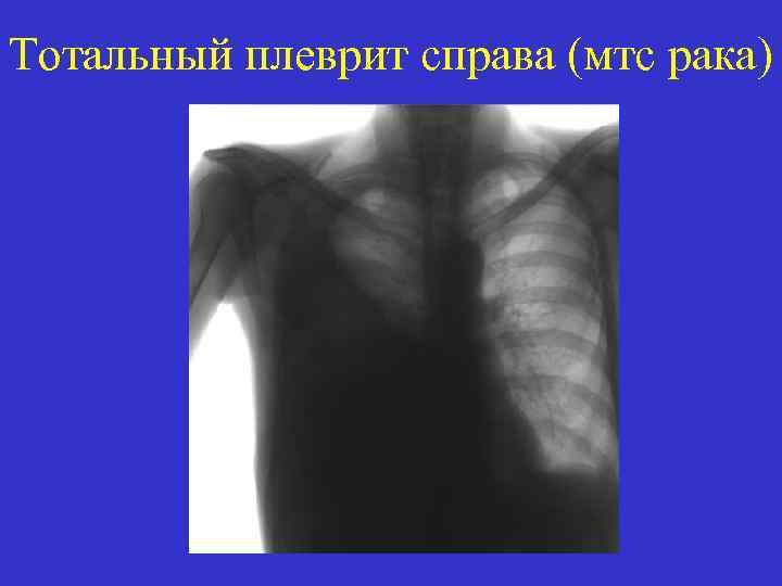 Тотальный плеврит справа (мтс рака) 