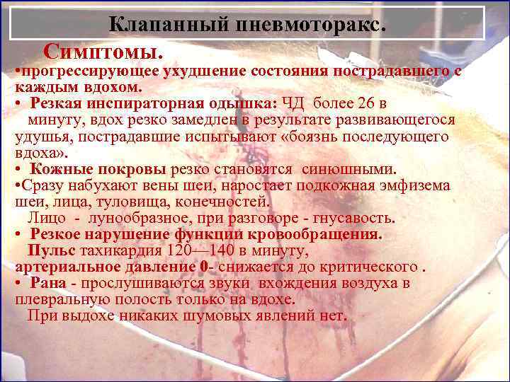 Клапанный пневмоторакс. Симптомы. • прогрессирующее ухудшение состояния пострадавшего с каждым вдохом. • Резкая инспираторная