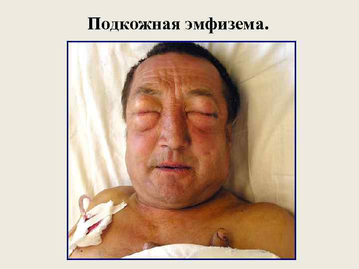 Подкожная эмфизема. 