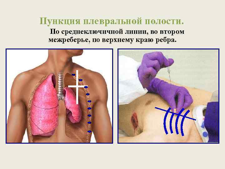 Пункция плевральной полости. По среднеключичной линии, во втором межреберье, по верхнему краю ребра. 