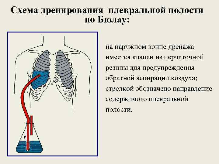 Схема дренирования плевральной полости по Бюлау: на наружном конце дренажа имеется клапан из перчаточной