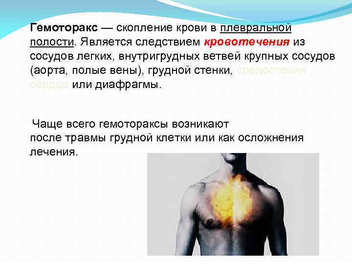 Гемоторакс — скопление крови в плевральной полости. Является следствием кровотечения из сосудов легких, внутригрудных
