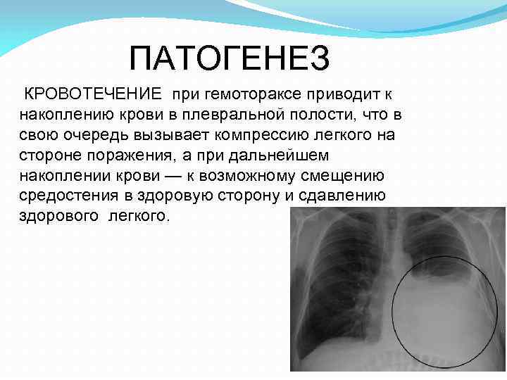 Гемоторакс карта вызова