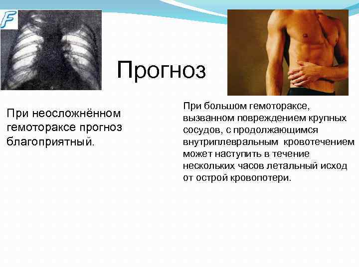  Прогноз При неосложнённом гемотораксе прогноз благоприятный. При большом гемотораксе, вызванном повреждением крупных сосудов,