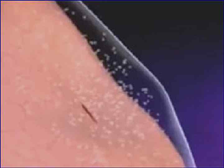 Виды пневмоторакса. открытый закрытый наружный клапанный внутренний 