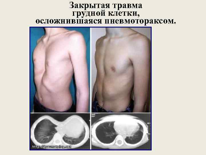 Закрытая травма грудной клетки, осложнившаяся пневмотораксом. 