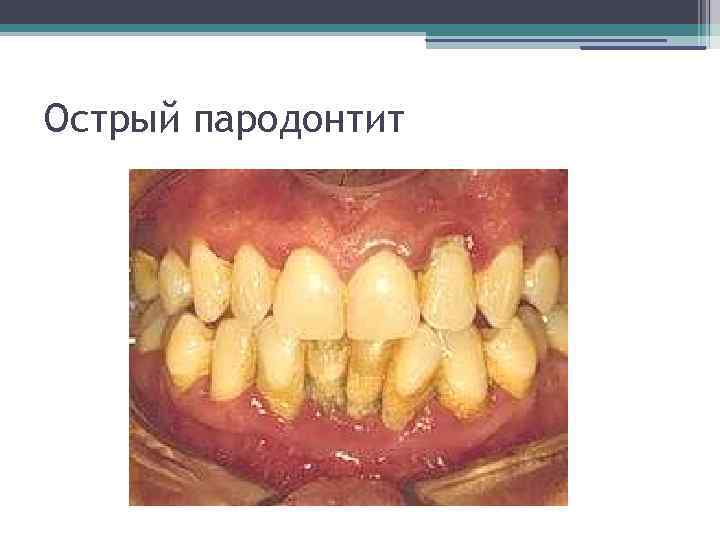 Острый пародонтит 
