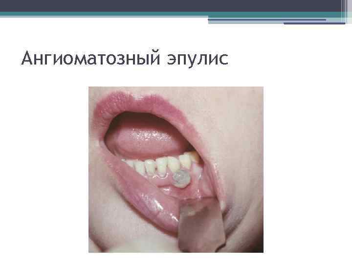 Ангиоматозный эпулис 