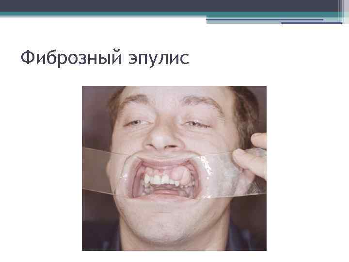 Фиброзный эпулис 