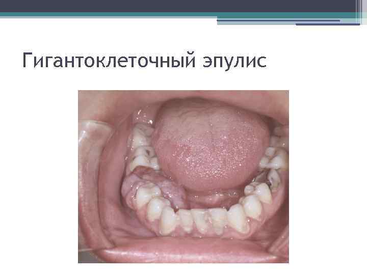 Гигантоклеточный эпулис 