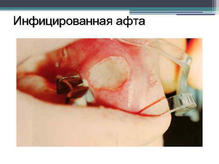 Инфицированная афта 