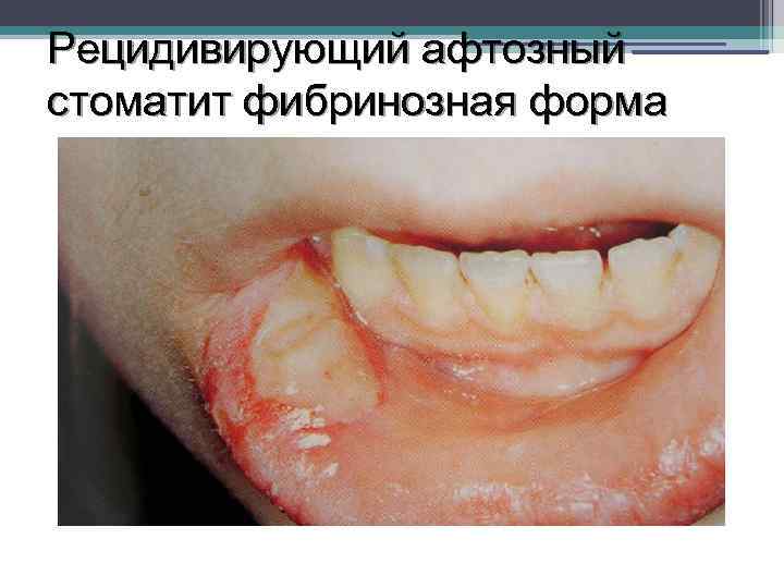 Рецидивирующий афтозный стоматит фибринозная форма 