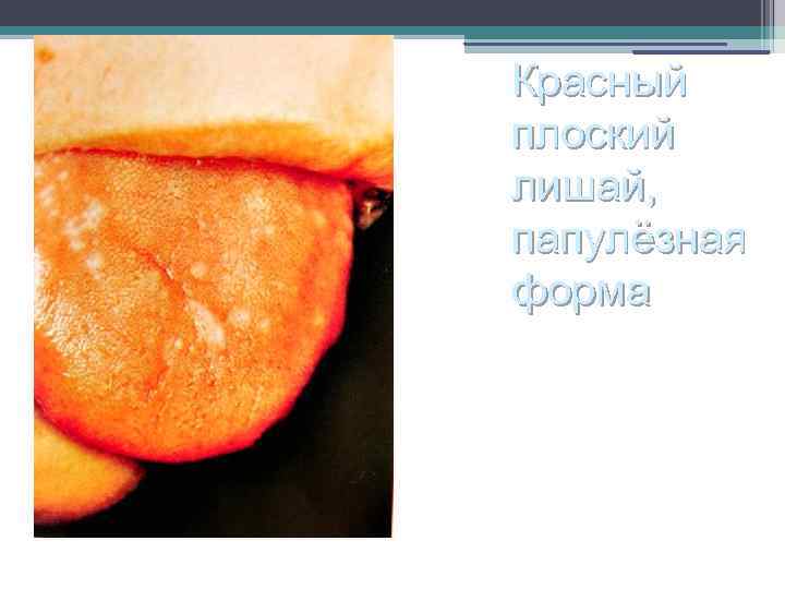 Красный плоский лишай, папулёзная форма 
