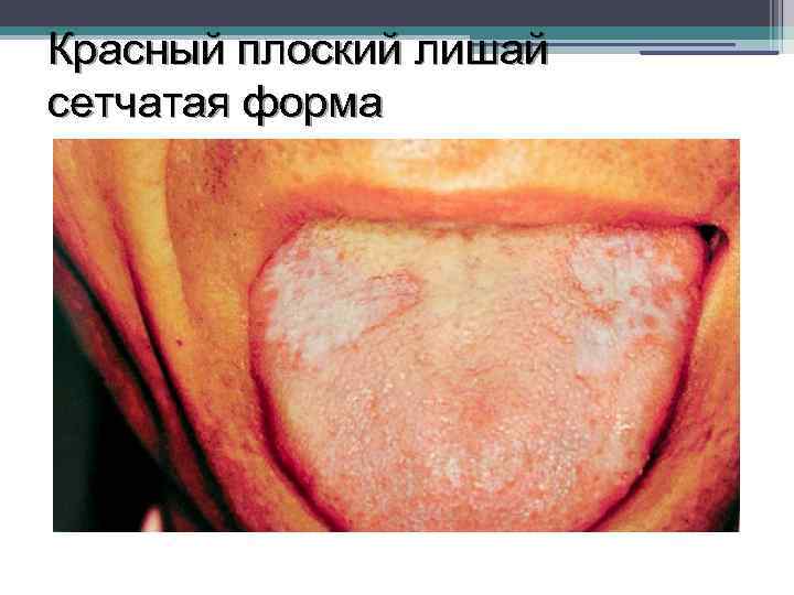 Красный плоский лишай сетчатая форма 