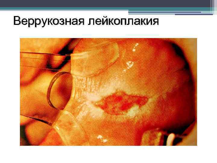 Веррукозная лейкоплакия 