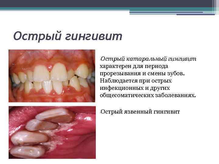 Острый гингивит презентация