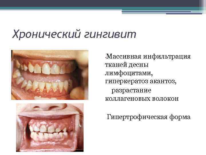 Хронический гингивит Массивная инфильтрация тканей десны лимфоцитами, гиперкератоз акантоз, разрастание коллагеновых волокон • Гипертрофическая