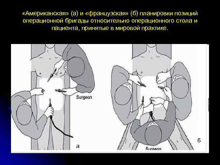  «Американская» (а) и «французская» (б) планировки позиций операционной бригады относительно операционного стола и