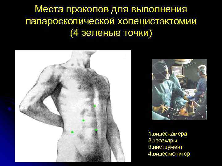 Места проколов для выполнения лапароскопической холецистэктомии (4 зеленые точки) 1. видеокамера 2. троакары 3.
