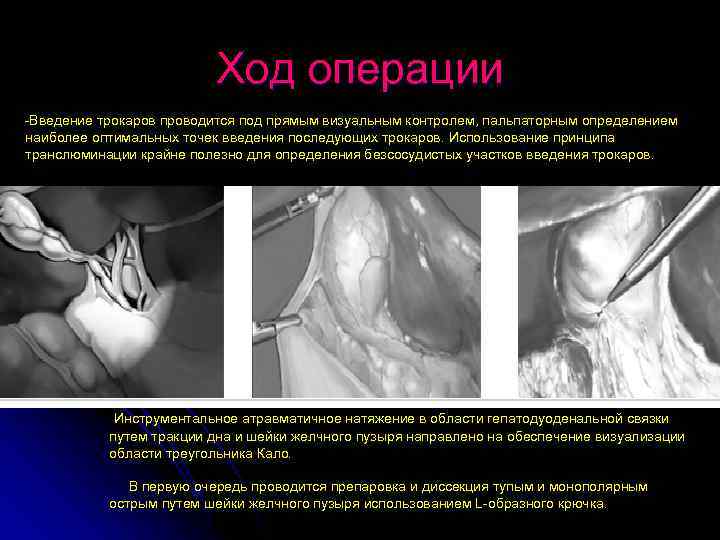 Ход операции -Введение трокаров проводится под прямым визуальным контролем, пальпаторным определением наиболее оптимальных точек