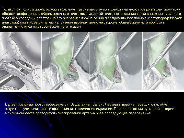 Только при полном циркулярном выделении трубчатых струткут шейки желчного пузыря и идентификации области конфлюенса