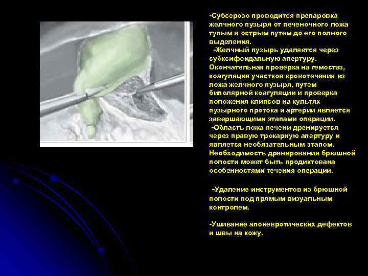 -Субсерозо проводится препаровка желчного пузыря от печеночного ложа тупым и острым путем до его