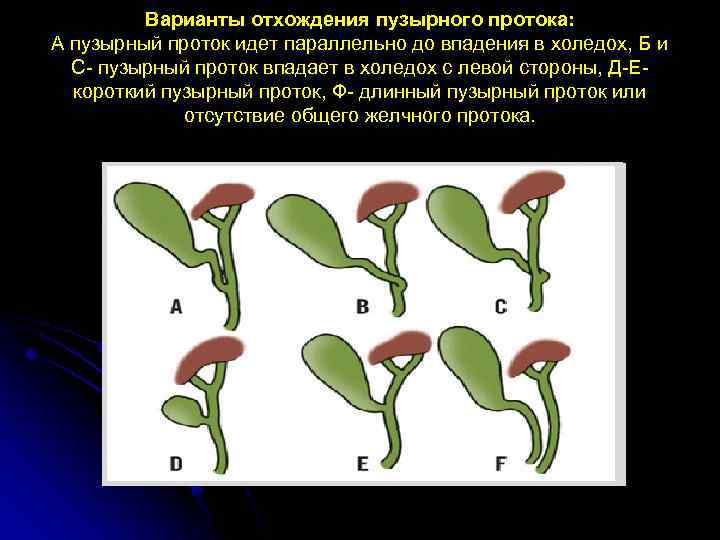 Варианты отхождения пузырного протока: А пузырный проток идет параллельно до впадения в холедох, Б