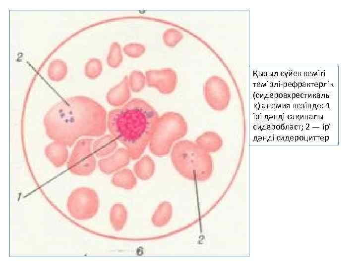 Қызыл сүйек кемігі темірлі-рефрактерлік (сидероахрестикалы қ) анемия кезінде: 1 ірі дәнді сақиналы сидеробласт; 2