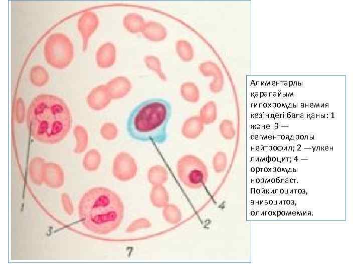 Алиментарлы қарапайым гипохромды анемия кезіндегі бала қаны: 1 және 3 — сегментоядролы нейтрофил; 2