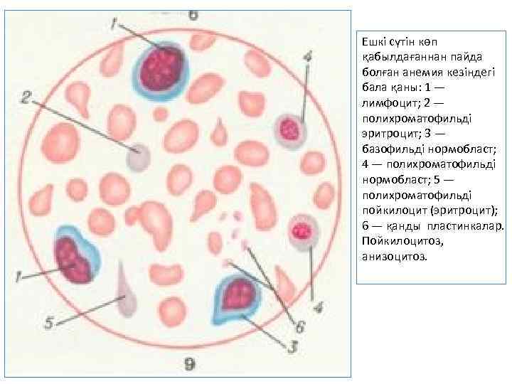 Ешкі сүтін көп қабылдағаннан пайда болған анемия кезіндегі бала қаны: 1 — лимфоцит; 2