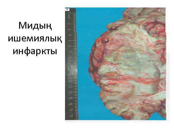 Мидың ишемиялық инфаркты 