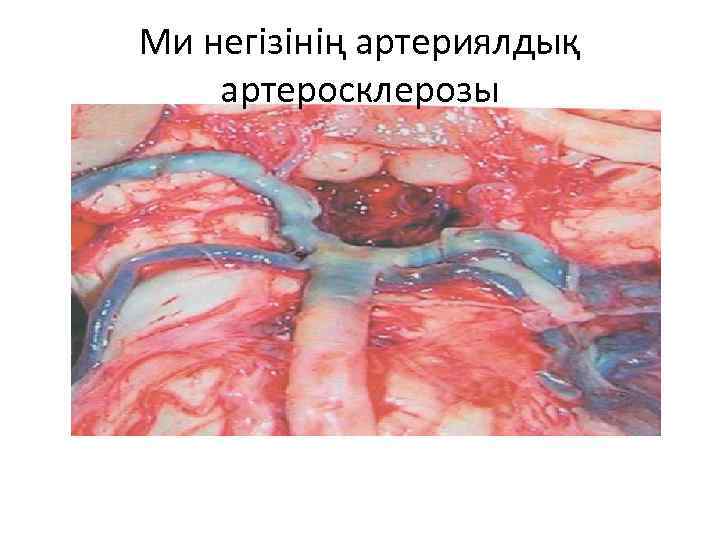 Ми негізінің артериялдық артеросклерозы 