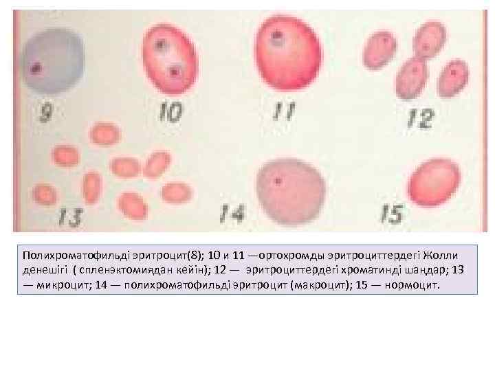 Полихроматофильді эритроцит(8); 10 и 11 —ортохромды эритроциттердегі Жолли денешігі ( спленэктомиядан кейін); 12 —